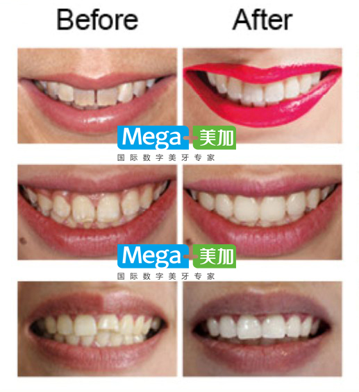 明星是怎么美白牙齿的,明星推荐牙齿美白最好的方法