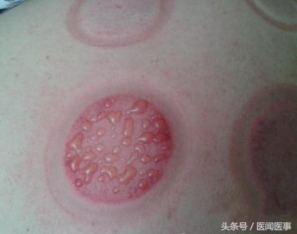 拔火罐拔出来的水泡真的是湿气吗,拔火罐拔出的湿气是肉湿还是外湿