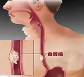 食道癌晚期可以活多久,晚期食道癌放疗能活多久