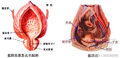 什么是盆腔炎理疗,什么是盆腔炎性疾病后遗症
