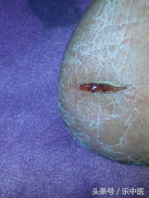 得了脚气很臭怎么办,得了脚气的四个阶段