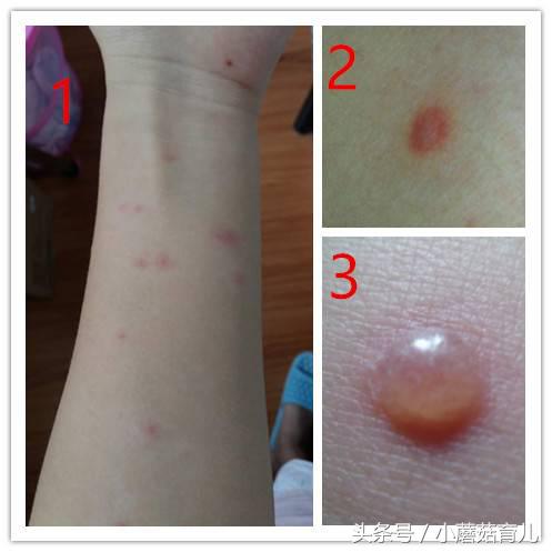 水痘有可能突然好了么,水痘高发易中招