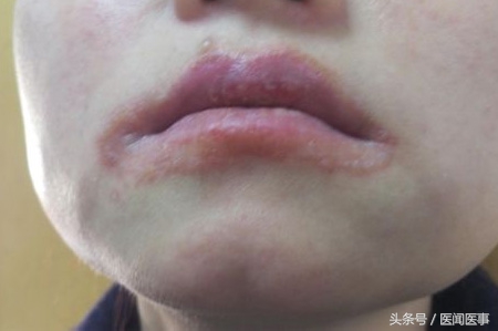嘴唇一到秋冬就干裂,进入秋冬嘴巴老是干裂