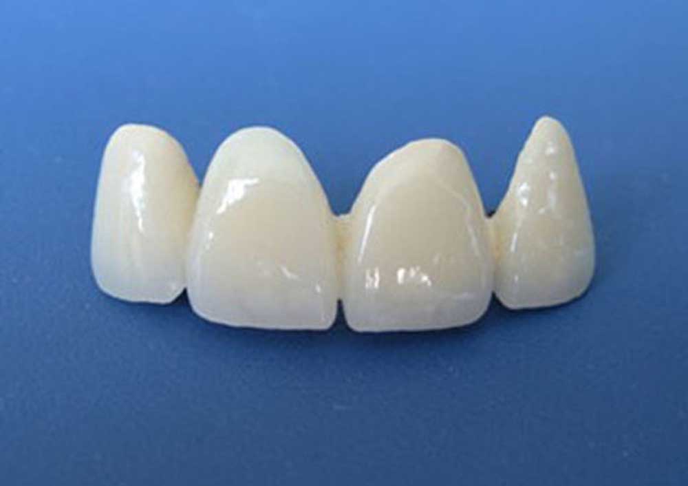 烤瓷牙里面的真牙一般几年会变黑,烤瓷牙与原来牙颜色有差异咋办