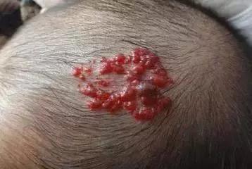 食管血管瘤能自愈吗,椎体血管瘤能自愈吗