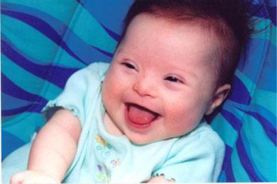 后期发现宝宝是唐氏综合征,唐氏综合征会长胖吗