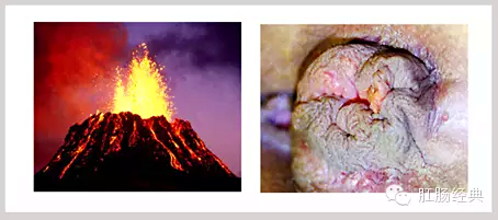 有趣痔疮的知识讲解,怪异的痔疮