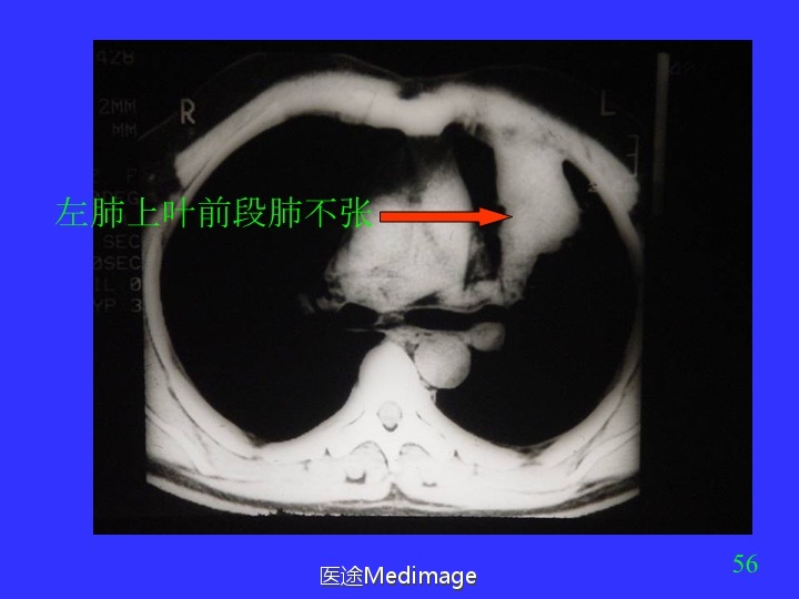 胸部ct扫描双肺未见明显异常,胸部ct报告心脏不大正常吗