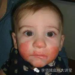 1度冻疮二度冻疮,冻疮预防常识有哪些