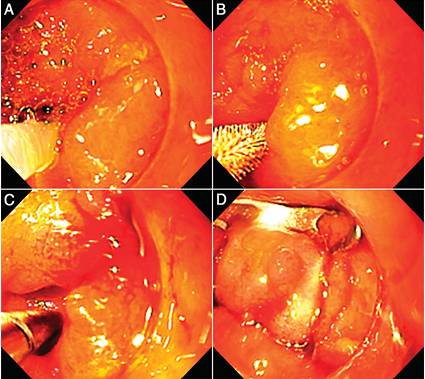 克罗恩病内镜严重程度指数,克罗恩病内镜检查是怎么样的