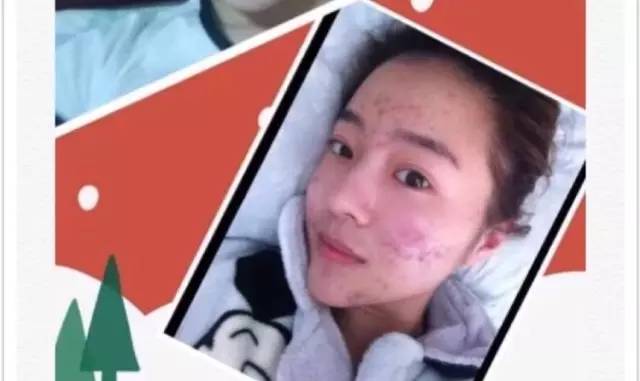 学生党痘痘黑头怎么解决,黑头贴祛痘