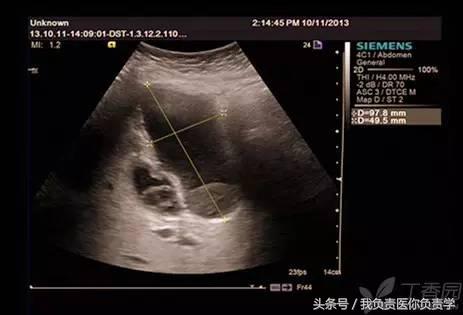 楂樻墜杩涢樁鑵拌吂璁粌,鑳嗗泭缁撶煶绌垮瓟鐥囩姸