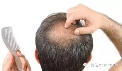 脂溢性脱发头顶脱发严重怎么办,头顶稀疏发缝宽脂溢性脱发怎么办