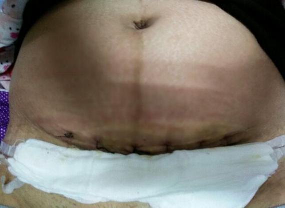 剖腹产要经过几道工序,剖腹产只需切一层