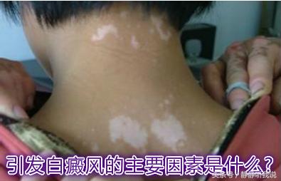 白癜风怎么才能有效控制,白癜风如何有效控制白癜风扩散