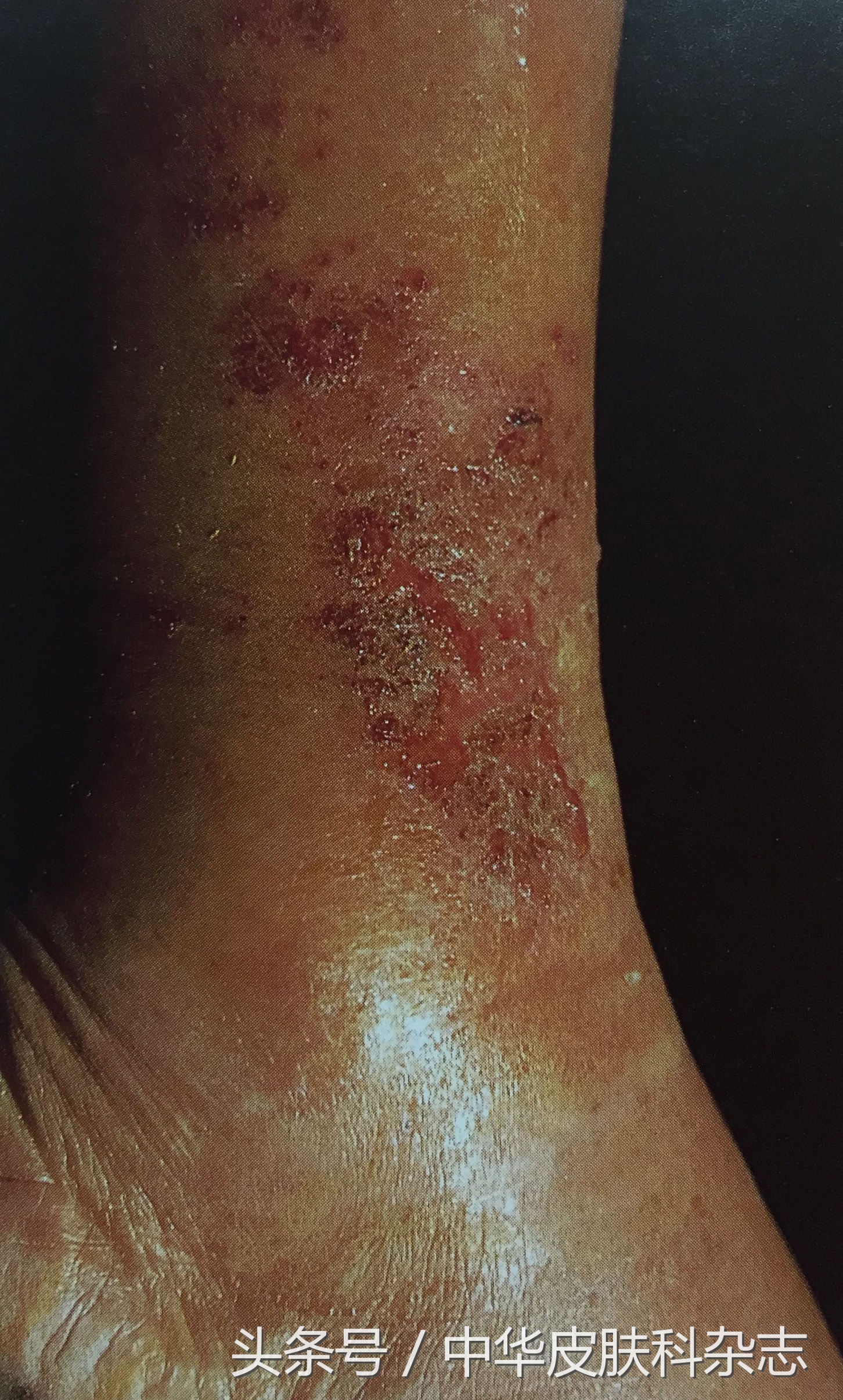 中西医结合治疗湿疹,特应性皮炎的湿疹中医治疗好吗