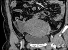病例丨病理结果「医看」有奖阅片大赛病例资料8：右侧卵巢纤维瘤#医学影像#