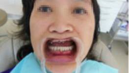 牙齿不齐可以戴隐形牙套吗,牙齿不齐一定要戴钢牙吗