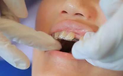 牙齿不齐可以戴隐形牙套吗,牙齿不齐一定要戴钢牙吗