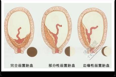 中央性前置胎盘为什么会大出血,前置胎盘16周大出血很多血块