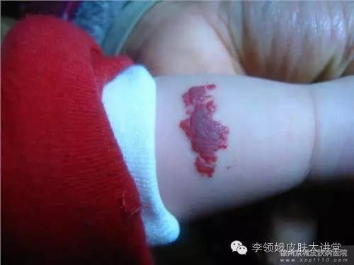 婴幼儿血管瘤边界欠清,婴幼儿血管瘤会破皮吗