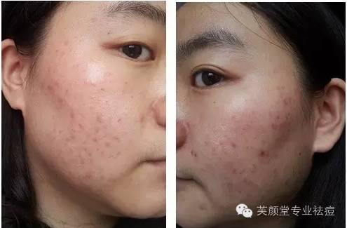 过敏长痘是什么原因,过敏长痘痘是什么症状