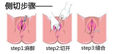 生孩子一定要顺产吗,生孩子一定要侧切吗