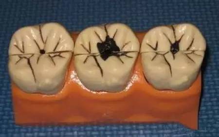 口臭是牙洞导致的吗,塞牙是不是导致口臭的直接原因