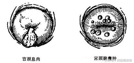 宫颈息肉吃达芙通预防,怎样预防宫颈息肉和宫颈糜烂