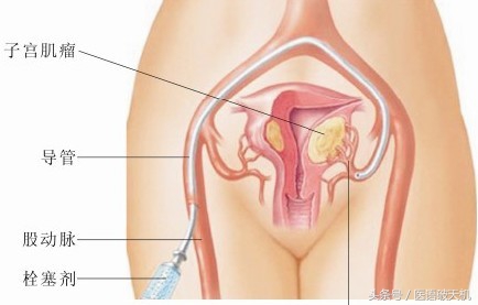 妇科最常见的肿瘤，到底应该怎么办