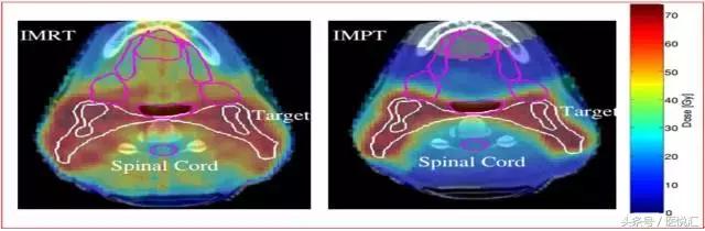 胡超苏治疗鼻咽癌案例,胡超苏鼻咽癌案例