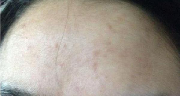 真正祛痘印有效的方法,最简单有效祛痘印的方法