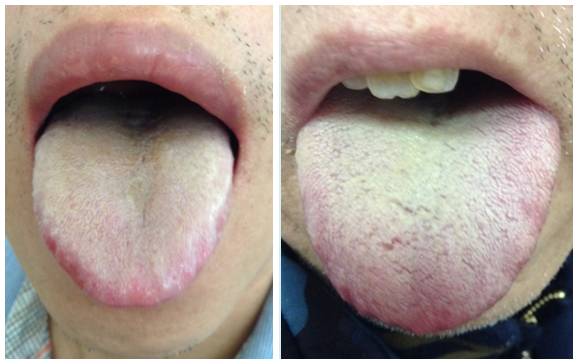 舌头看健康11种舌象代表的疾病,怎样的舌头才是健康的图片