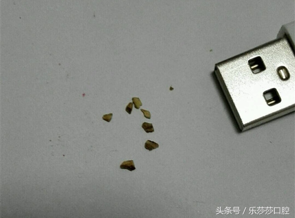牙结石自己掉了一块超级臭,用手抠掉了一块牙结石