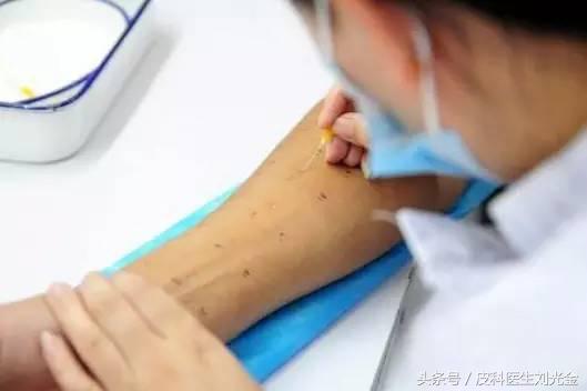 过敏原检测都能查出什么过敏原,查过敏原有哪种方法