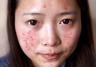 小孩脸上密密麻麻小疙瘩不痛不痒,脸上不痛不痒的小疙瘩是什么