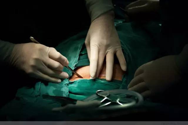 剖腹产恢复很好的照片,剖腹产完全恢复照片