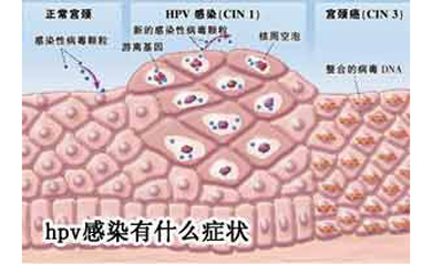 尖锐湿疣,中医内外合治有3个原则