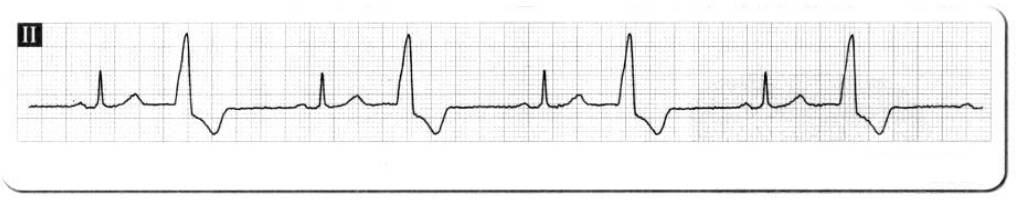 服用什么药物心电图就会正常,服药后做心电图