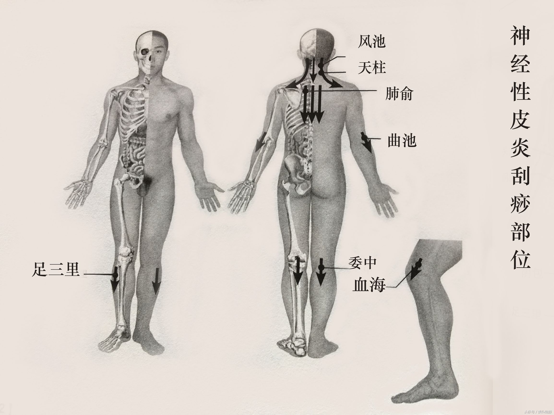 牛皮癣痒用刮痧办法行吗,身上有股癣神经性皮炎银屑病
