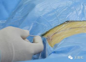 “钥匙孔”解决腰腿痛,骨科治疗新技术(内含术中图片)