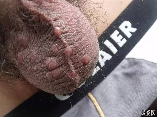 疥疮有什么更好的方法可以拯救,疥疮治愈的小妙招