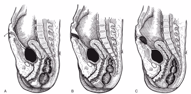 脐尿管闭合不全最迟多久能愈合,肚脐渗水用什么药好