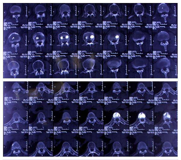 陈旧胸椎压缩性骨折治好的案例,年轻人胸椎压缩性骨折的康复患者