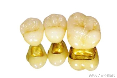 整牙真的可以变脸!想做烤瓷牙的看过来:烤瓷牙种类及各自优缺点