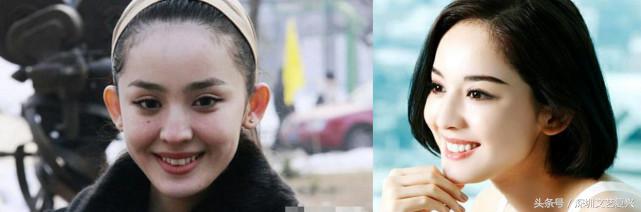 林允整牙效果怎么样,林允整牙后变化图片