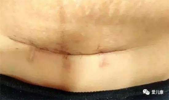 剖腹产伤疤怎么恢复好,剖腹产伤疤修复方法