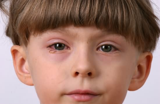 婴幼儿结膜炎怎么快速治愈,怎么舒缓结膜炎引起的眼睛胀痛