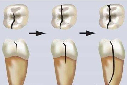 牙齿骨折错位保守治疗能自愈吗,牙齿骨折治疗方法