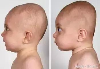 头丑随一生!千万别错过宝宝头型矫正黄金期